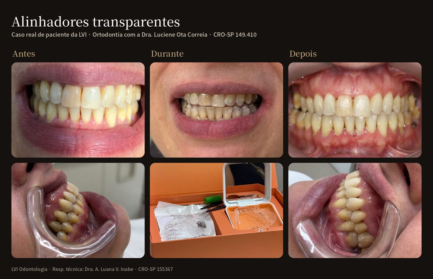 Antes, durante e depois de tratamento com alinhadores transparentes