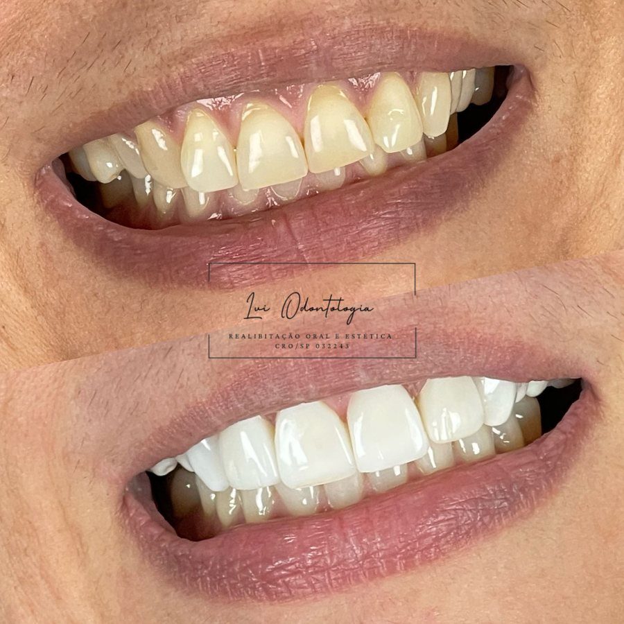 Antes e depois de facetas dentárias