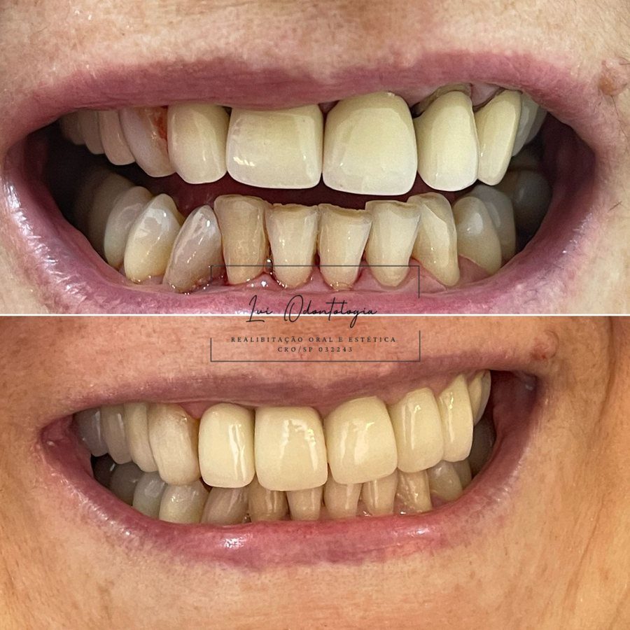 Antes e depois de reabilitação oral