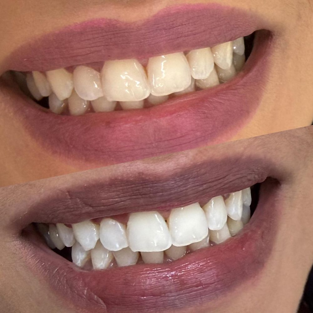 Antes e depois de clareamento dental