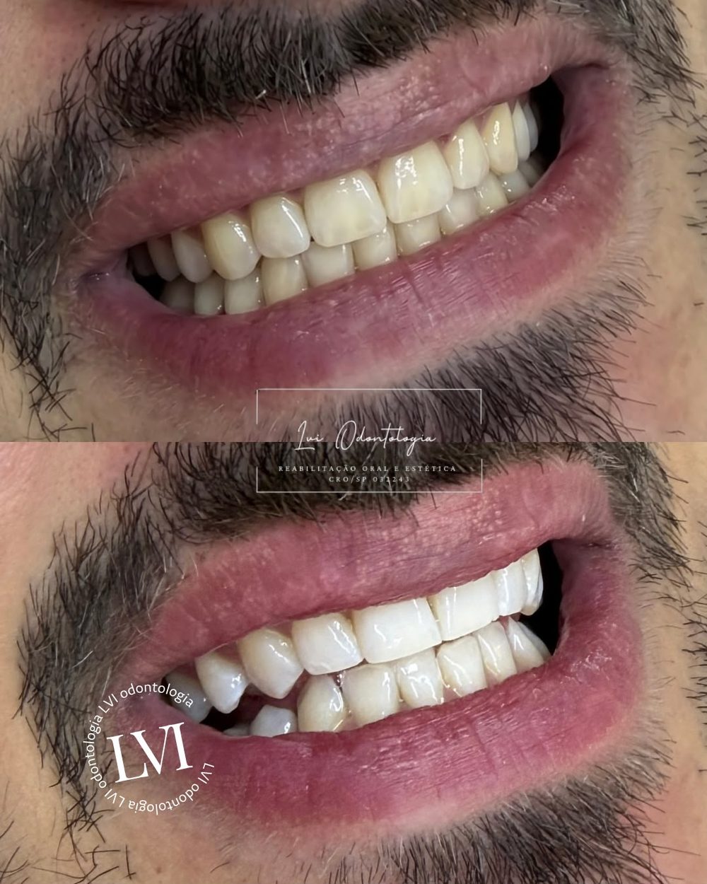 Antes e depois de clareamento dental