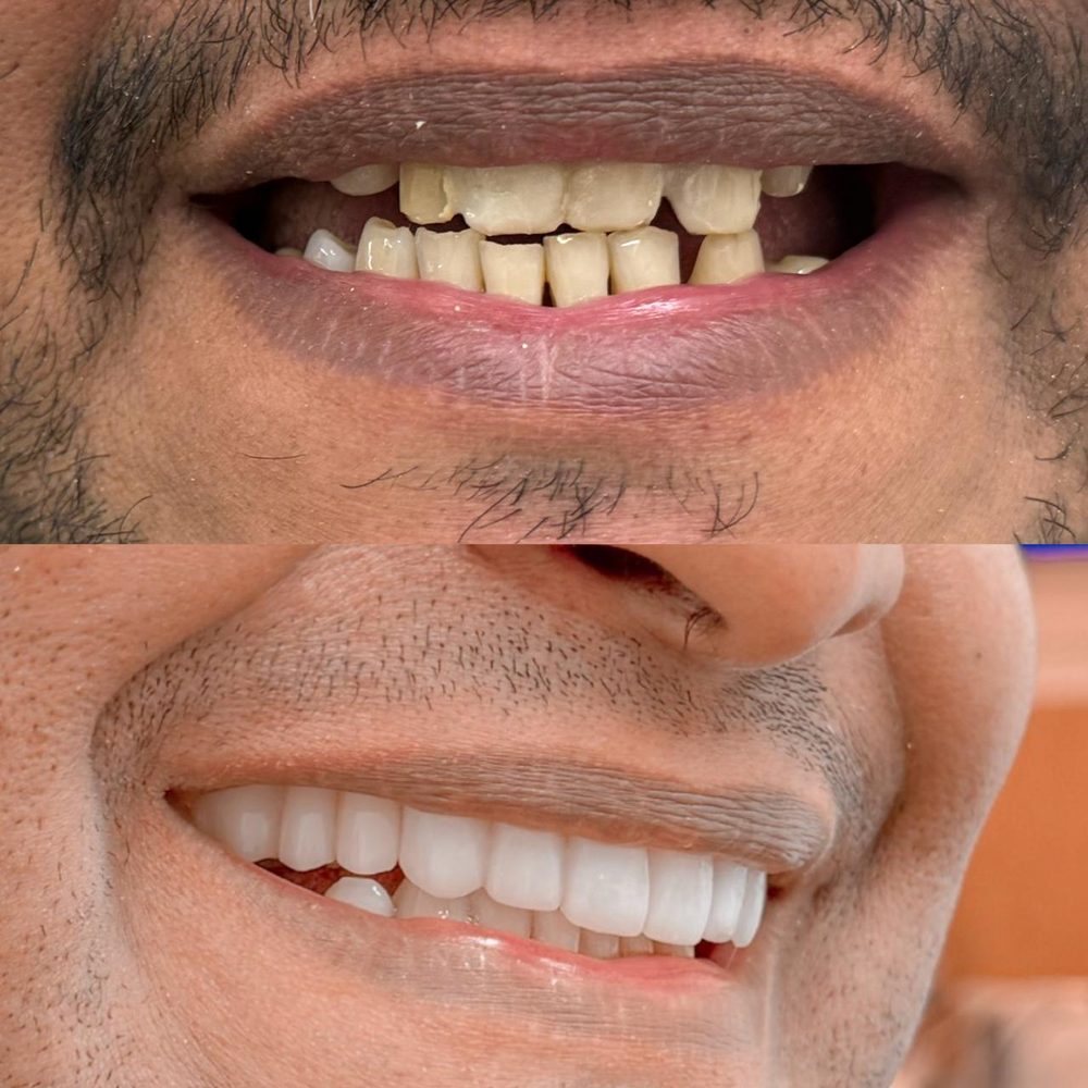 Antes e depois de reabilitação oral