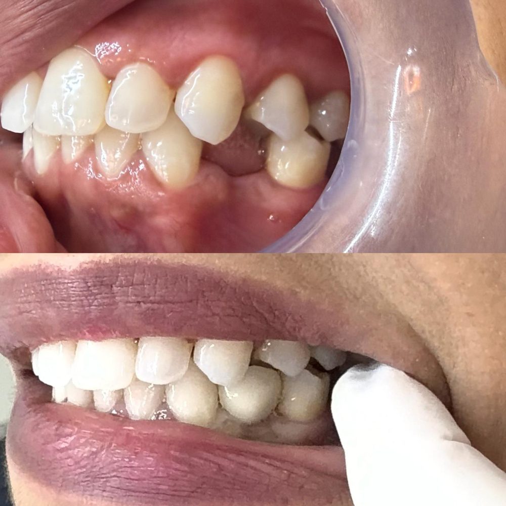 Antes e depois de implante dentário