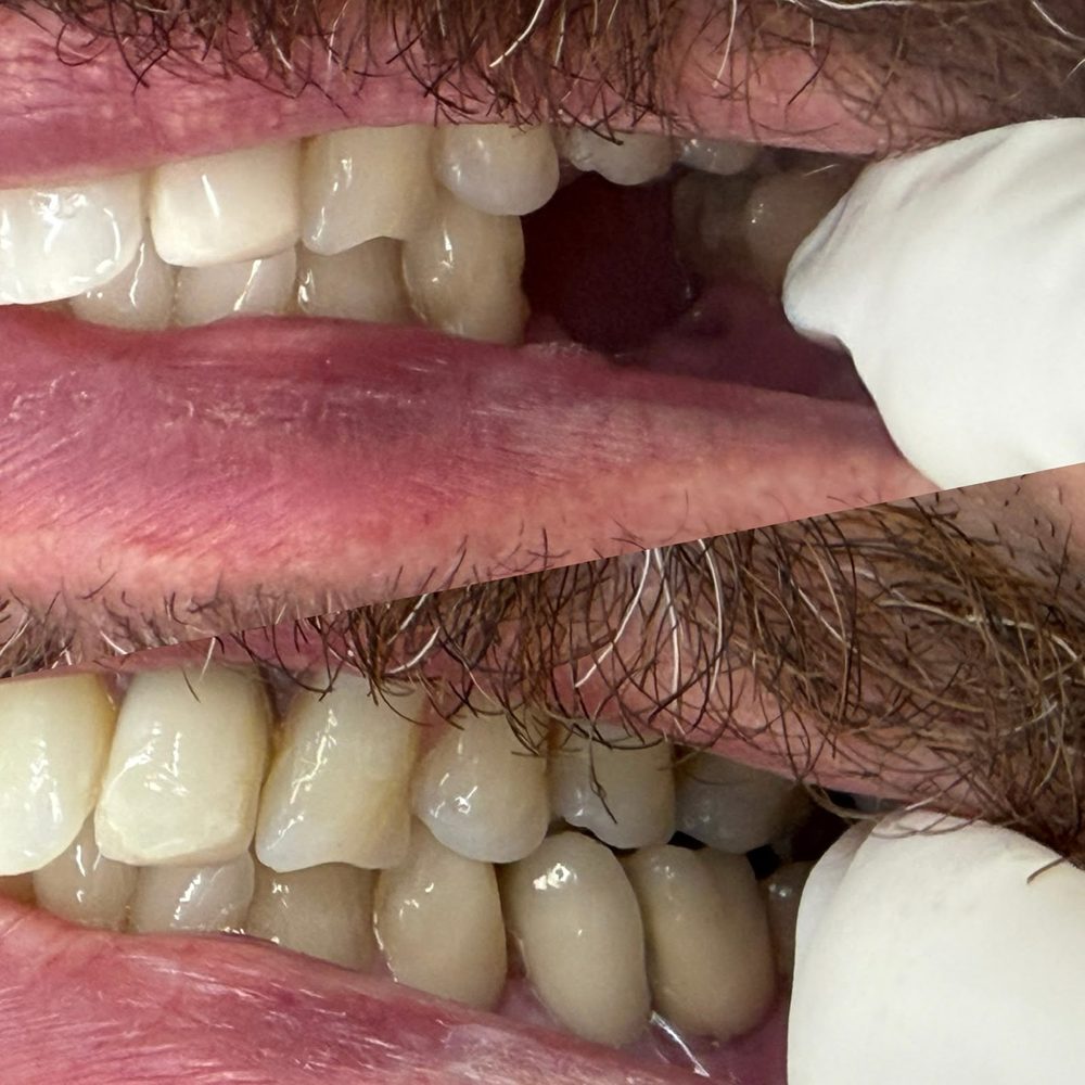 Antes e depois de implante dentário
