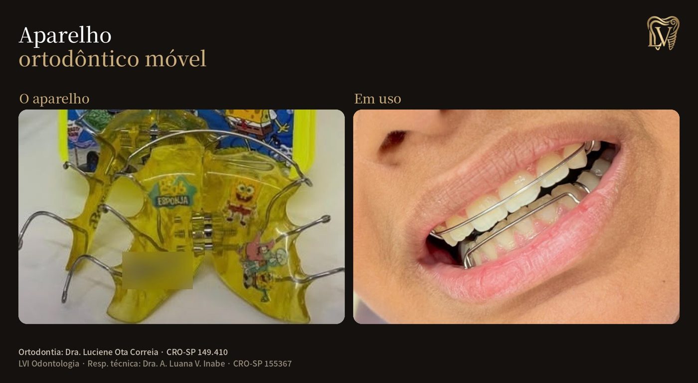 Aparelho ortodôntico móvel infantil e em uso